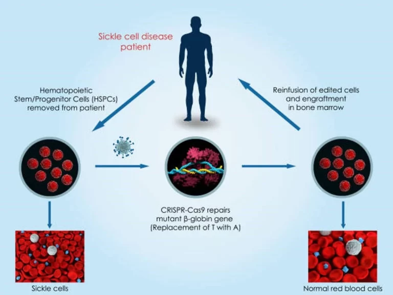 Figure 2: Sickle Cell Treatment via CRISPR (source: Synthego