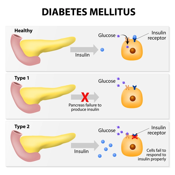Figure 1: The different types of diabetes